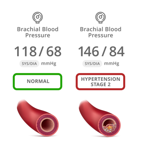 Interpreting Your Brachial Blood Pressure Results Using The Pulse ...