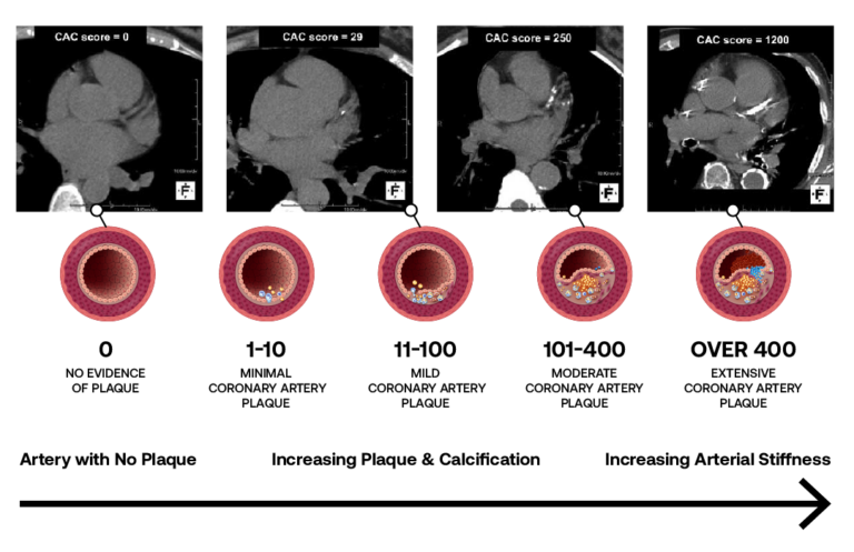 Augmentation Scae Interpreting Your Augmentation Index and Augmentation Pressure Results ...
