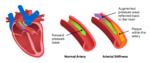 Augmentation Pressure and Index: Understanding AP and AIx