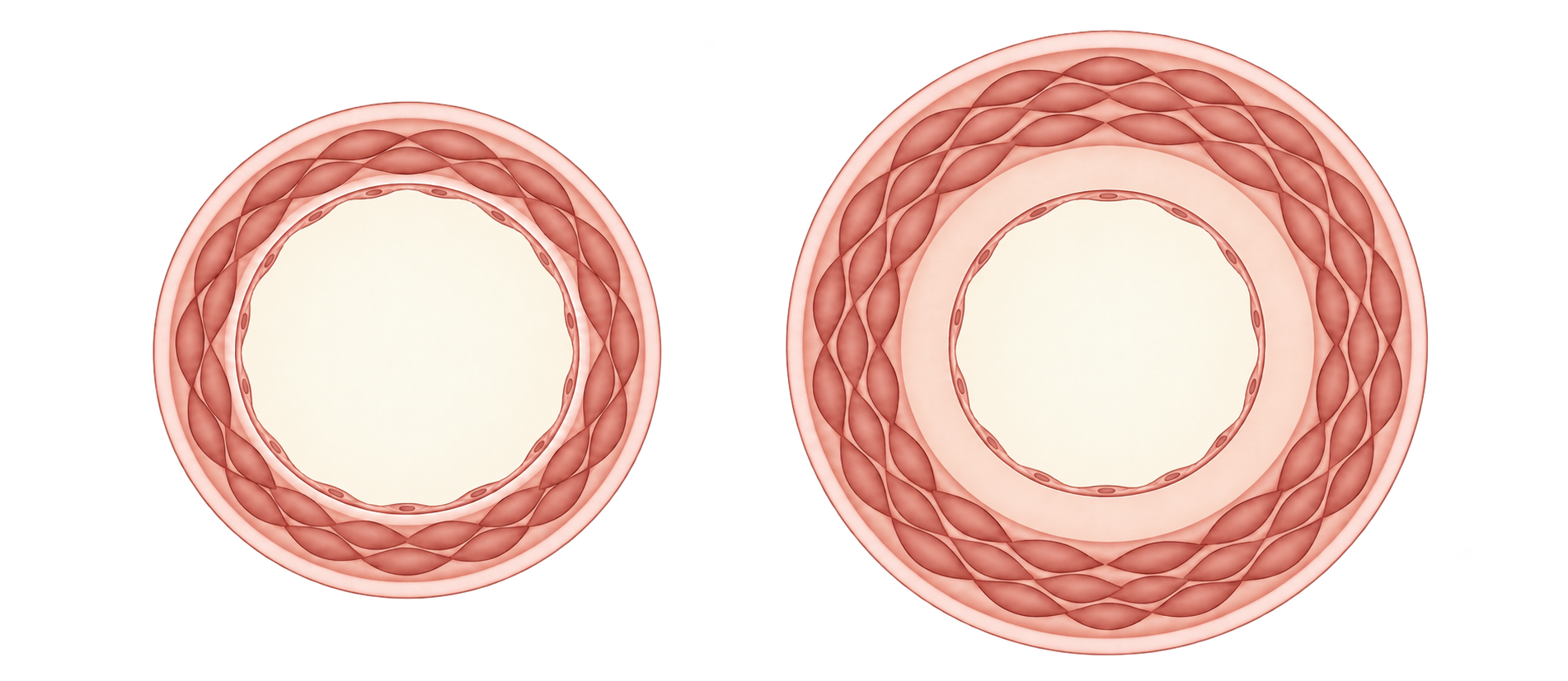 Simplified artery wall cross-sections: a thin inner layer and muscle wall on the left, and thicker inner and muscle layers with a larger outer diameter on the right; both central openings remain clear